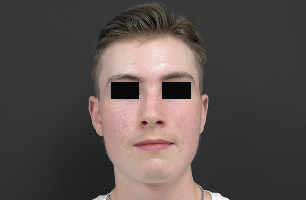 Acne Laser Therapy: A Modern Approach to Clearer Skin Acne Laser Therapy: A Modern Approach to Clearer Skin